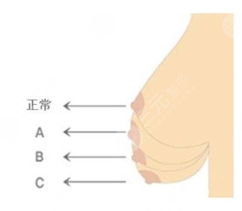 隆胸