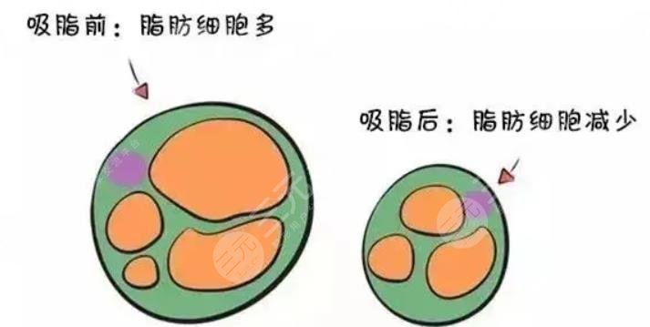 如何瘦腿