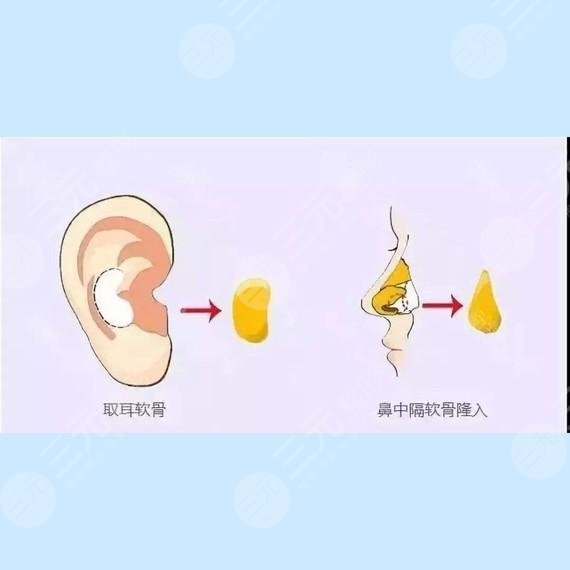 耳软骨隆鼻的优点有哪些
