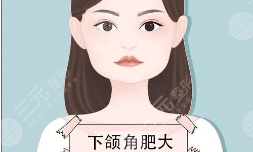 尖下颌角整形前后注意点有哪些
