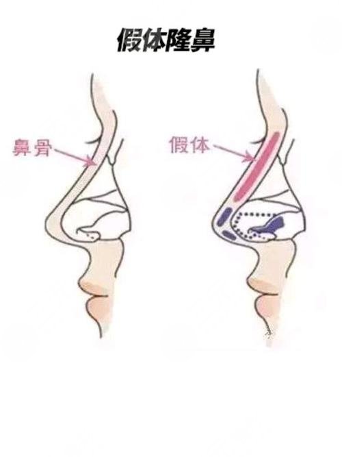 鼻子假体取出后多久可以恢复
