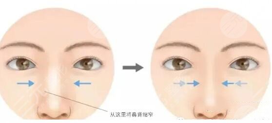 濡白天使隆鼻优势