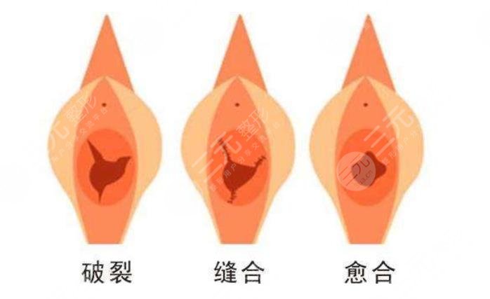 女性(内膜)处女膜修复多少钱？私密整形价格参考+注意事项汇总！