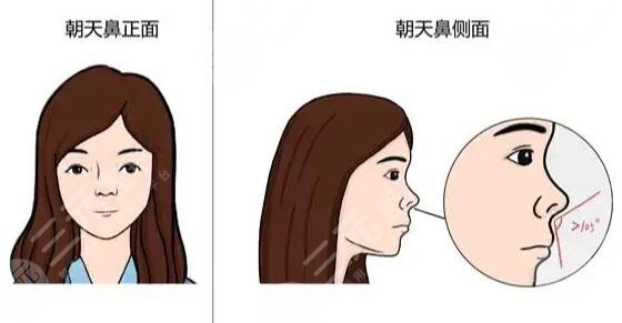 朝天鼻纠正整形手术费用多少钱？一个手术让你拥有爆款颜值！对比强烈~