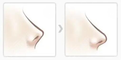 朝天鼻纠正整形手术费用多少钱？