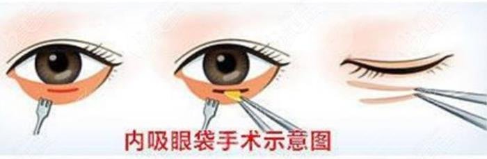 去眼袋