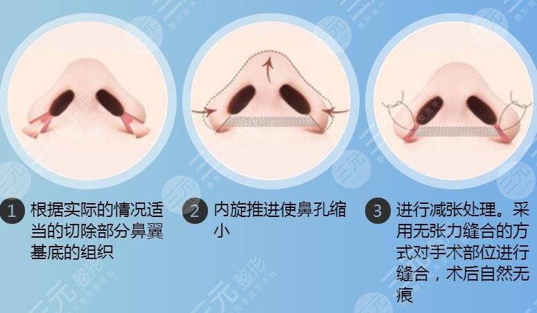 鼻翼缩小手术风险大吗?