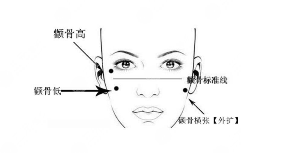 颧骨高改善的手术的注意事项