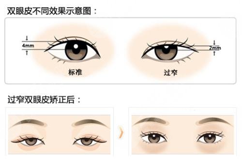 三点定位双眼皮优势盘点