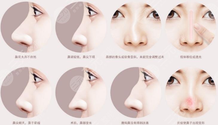鼻部修复假体取出容易吗?