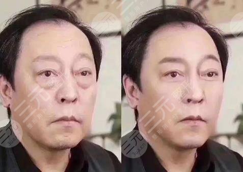 超声波去眼袋