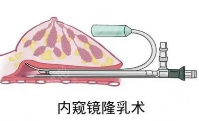 内窥镜隆胸手术