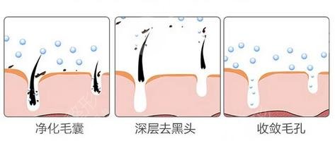 去黑头