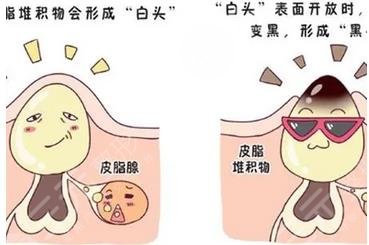 去黑头