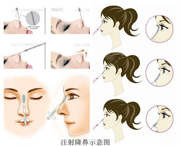 玻尿酸隆鼻的价格是多少?