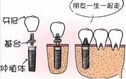 牙齿种植原理