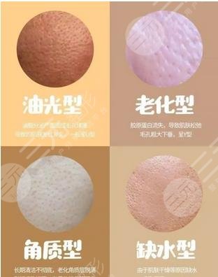 毛孔类型