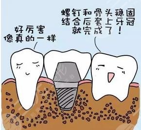 种牙