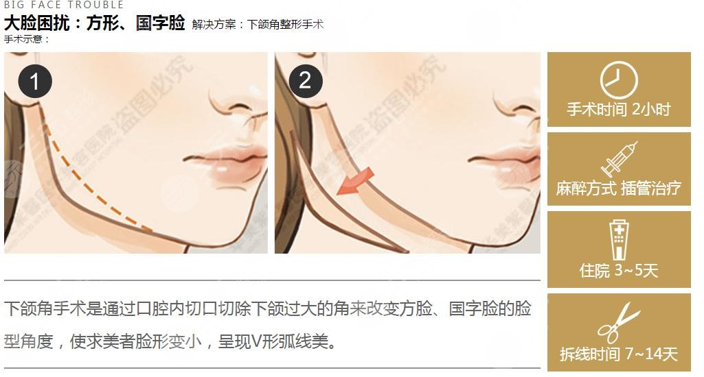 做颧骨改善手术之前要注意什么