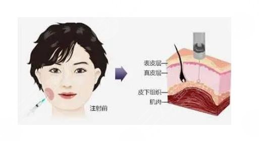 注射瘦脸会反弹吗?术后注意事项有哪些?