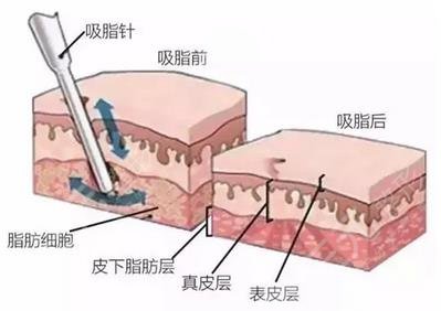 吸脂减肥