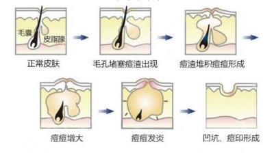 激光祛痘大概需要多久?