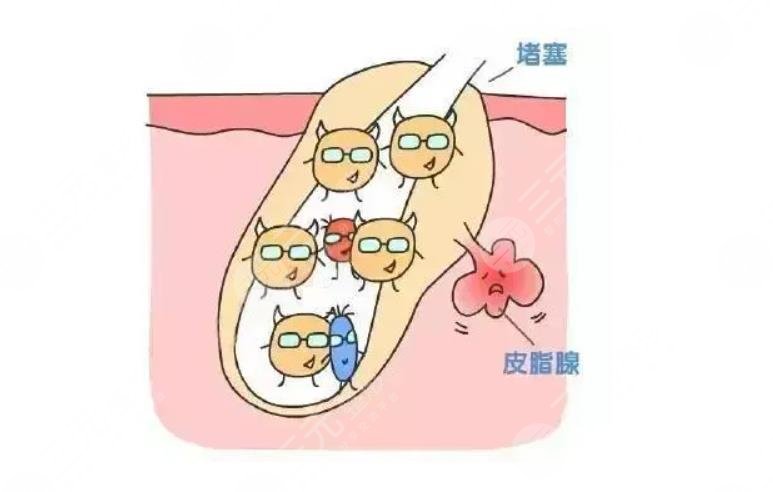 激光祛痘的价格是多少?多少钱一次?