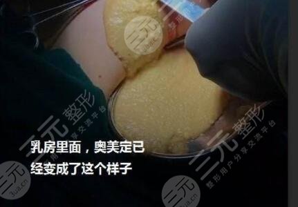 取奥美定可以医保报销吗？