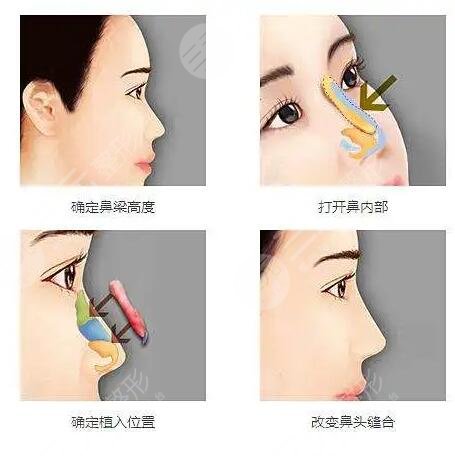 韩式三段隆鼻手术的费用要多少呢?