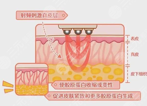 热拉提和热玛吉的效果区别