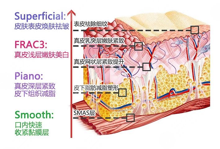 欧洲之星fotona4dpro效果怎么样?原理、功效等超全盘点!30岁以上抗衰必看~