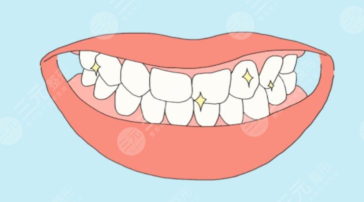 冷光美白牙齿要多少钱一次?价格参考