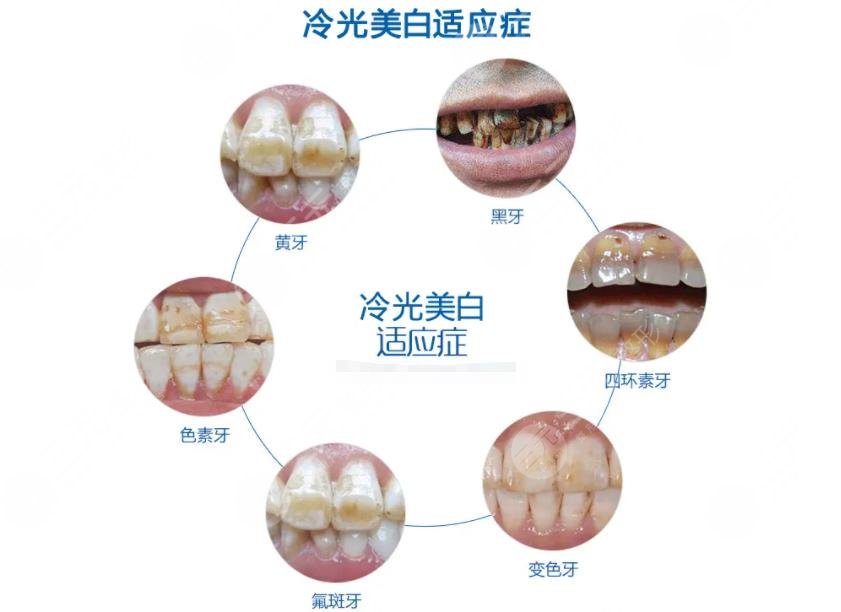 冷光美白牙齿原理是什么?
