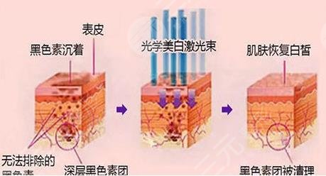 光子嫩肤需要每年做吗?