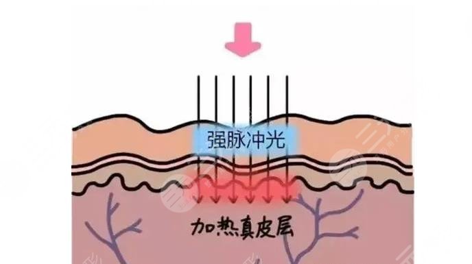 光子嫩肤是什么原理?