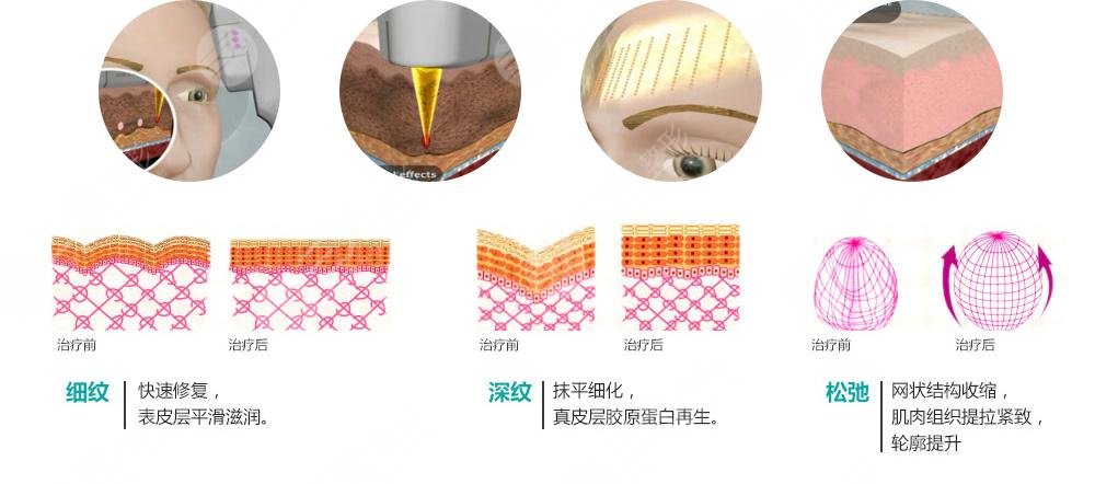 光子嫩肤一次多少钱?