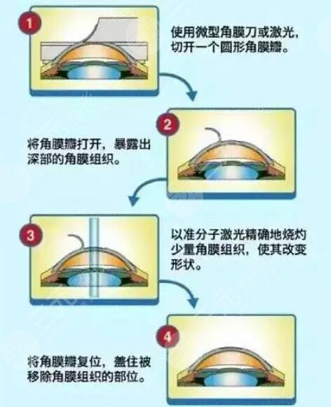深圳眼科近视矫正案例