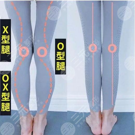 x型腿怎么矫正