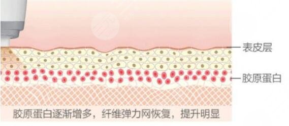 7d聚拉提的手术原理