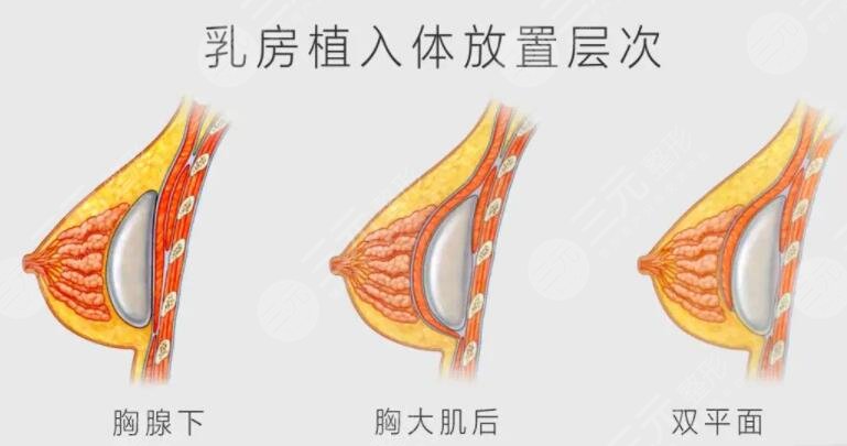 双平面隆胸优缺点都有哪些呢?