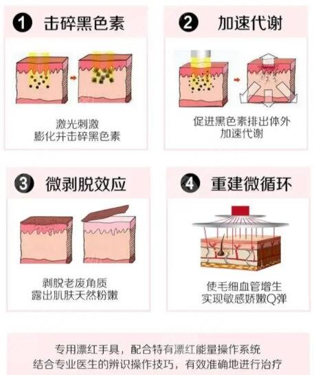 菲蜜丽做了之后的效果如何