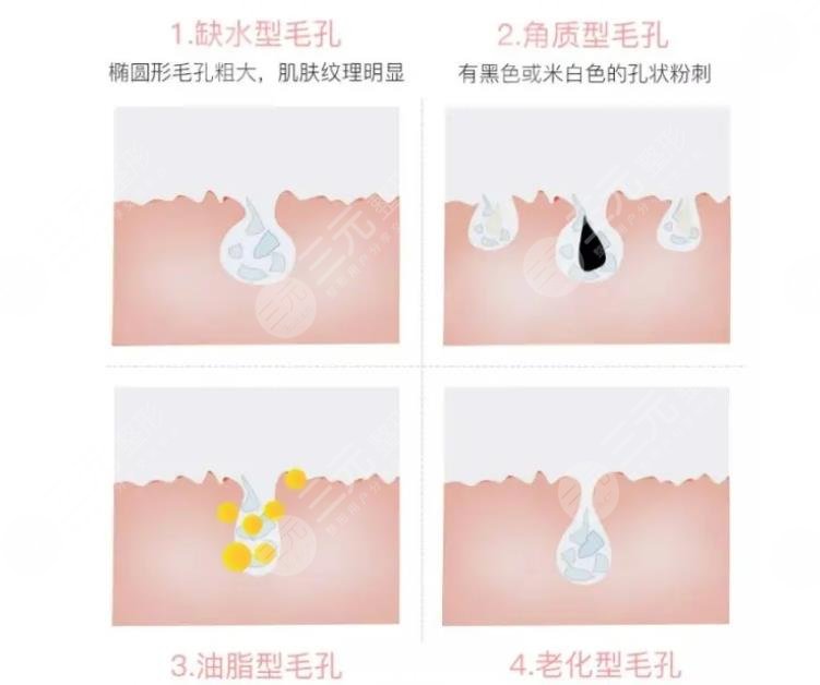 毛孔粗大是什么原因造成的?