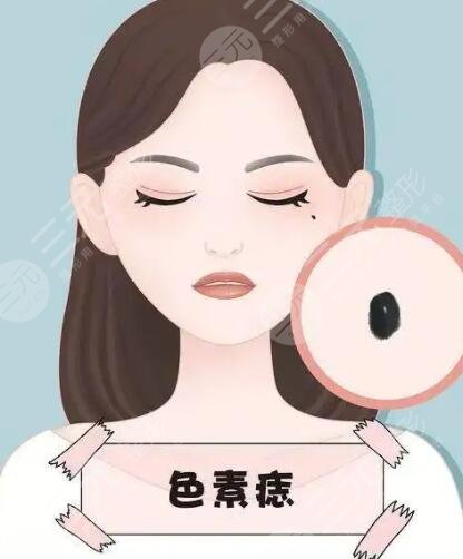 激光祛痣后