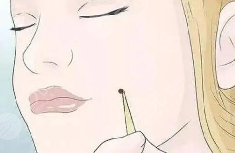 激光祛痣效果怎么样?真人案例
