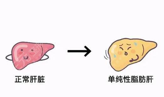 脂肪肝吃什么才能减掉肝上的脂肪?