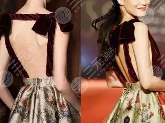 脊柱沟是天生的吗?