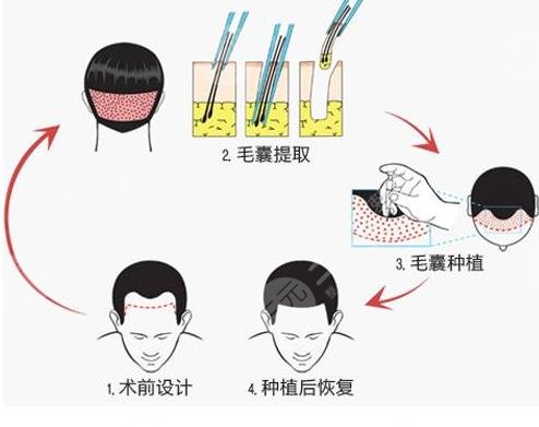 植发2000单位有多大面积