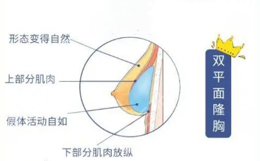 美国曼托假体