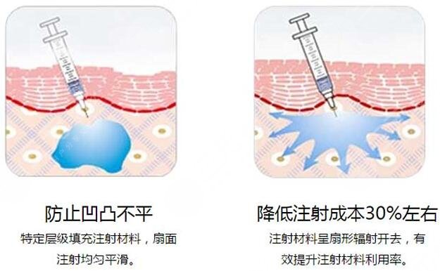 注射玻尿酸术前准备工作有哪些