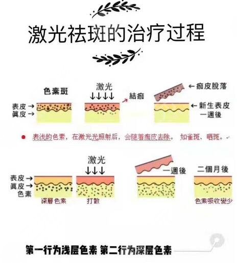 超英祛斑是什么？效果怎么样？